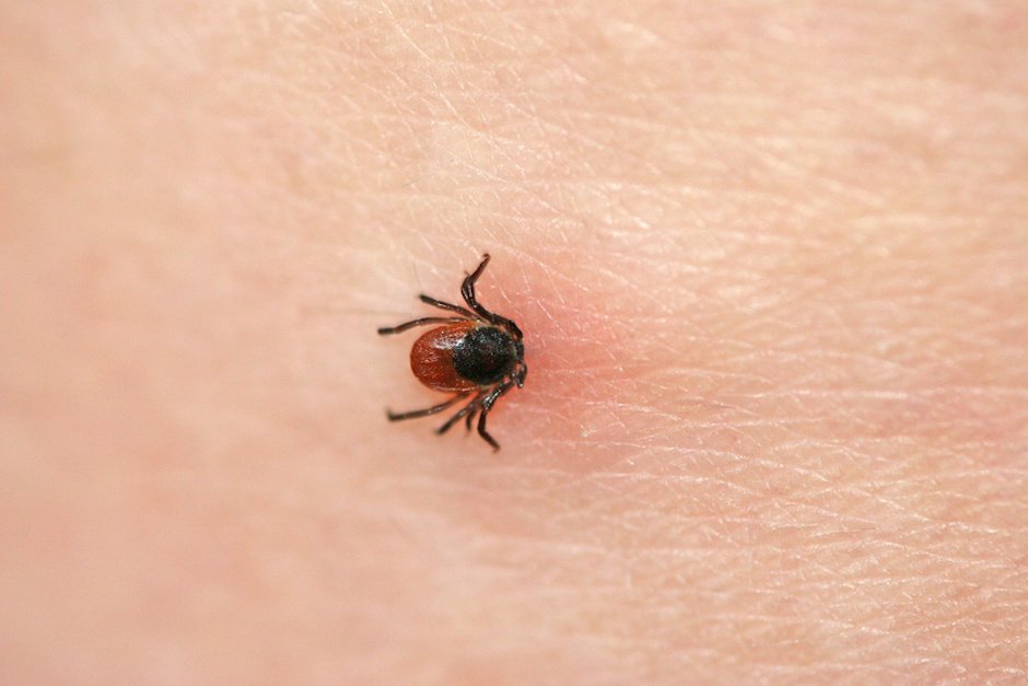 Zecke, Holzbock in Haut